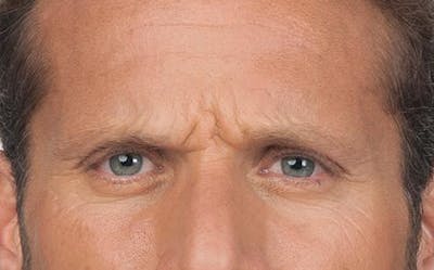 BOTOX for Men Before & After Gallery - Patient 362685 - Image 1