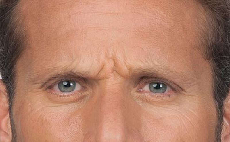 BOTOX for Men Before & After Gallery - Patient 362685 - Image 1
