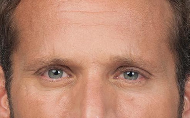 BOTOX for Men Before & After Gallery - Patient 362685 - Image 2