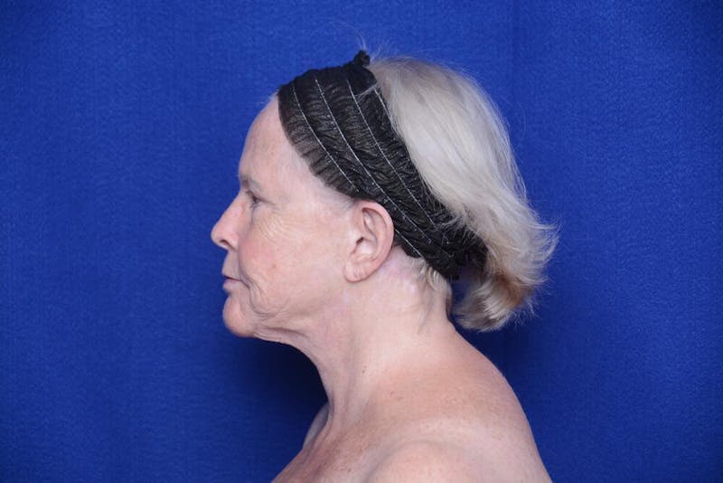 Brow Lift Before & After Gallery - Patient 410481 - Image 1