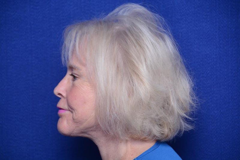 Brow Lift Before & After Gallery - Patient 410481 - Image 2