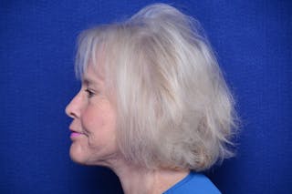 Brow Lift Before & After Gallery - Patient 410481 - Image 2