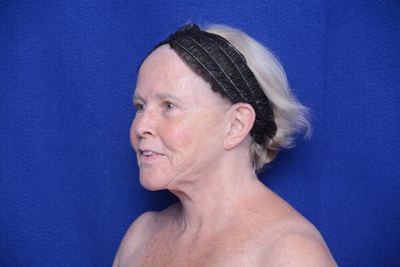 Brow Lift Before & After Gallery - Patient 410481 - Image 3