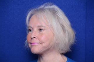 Brow Lift Before & After Gallery - Patient 410481 - Image 4