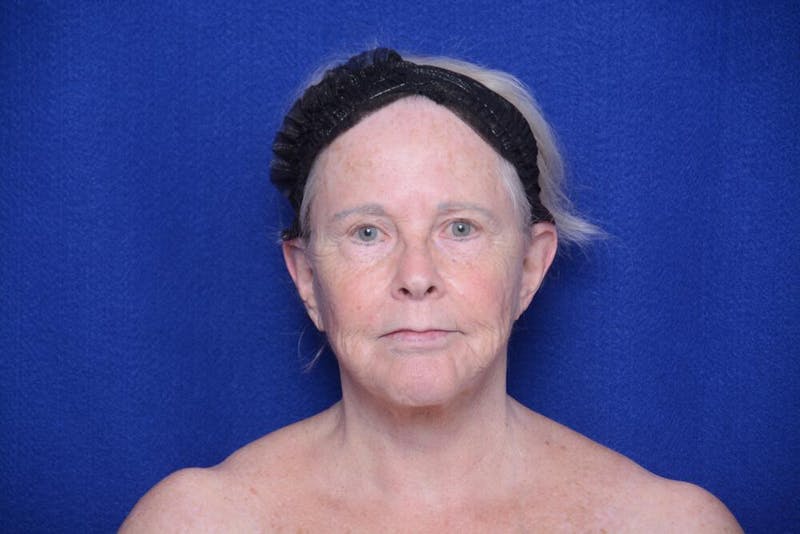 Brow Lift Before & After Gallery - Patient 410481 - Image 5