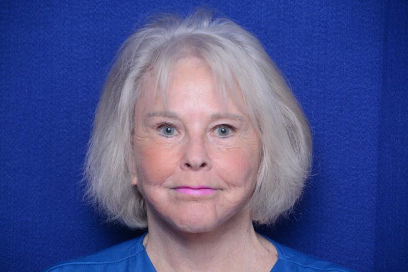 Brow Lift Before & After Gallery - Patient 410481 - Image 6