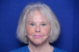 Brow Lift Before & After Gallery - Patient 410481 - Image 6