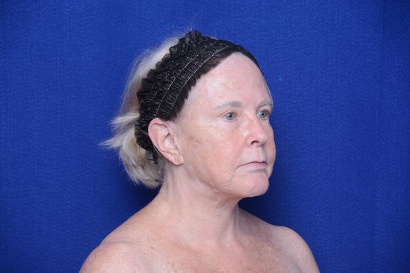 Brow Lift Before & After Gallery - Patient 410481 - Image 7