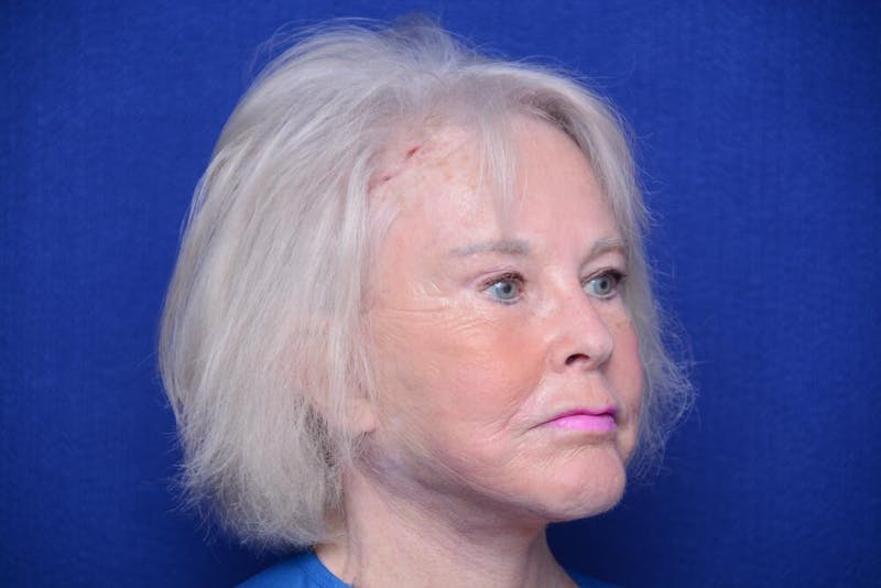 Brow Lift Before & After Gallery - Patient 410481 - Image 8