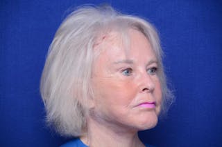 Brow Lift Before & After Gallery - Patient 410481 - Image 8