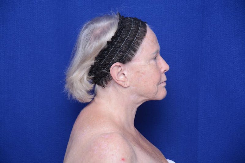 Brow Lift Before & After Gallery - Patient 410481 - Image 9