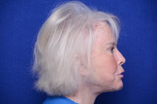 Brow Lift Before & After Gallery - Patient 410481 - Image 10