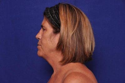 Brow Lift Before & After Gallery - Patient 119408 - Image 1