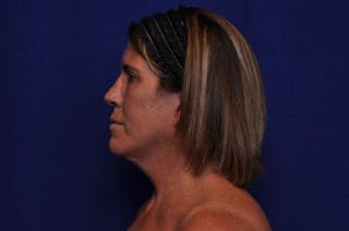 Brow Lift Before & After Gallery - Patient 119408 - Image 2