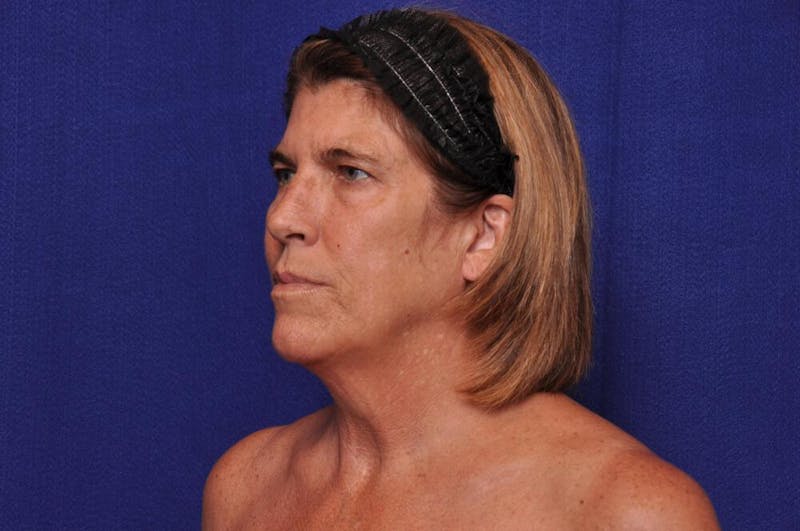Brow Lift Before & After Gallery - Patient 119408 - Image 3