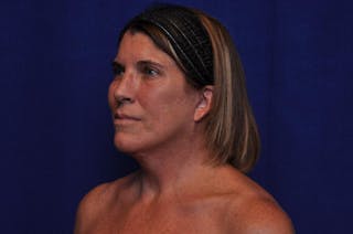 Brow Lift Before & After Gallery - Patient 119408 - Image 4