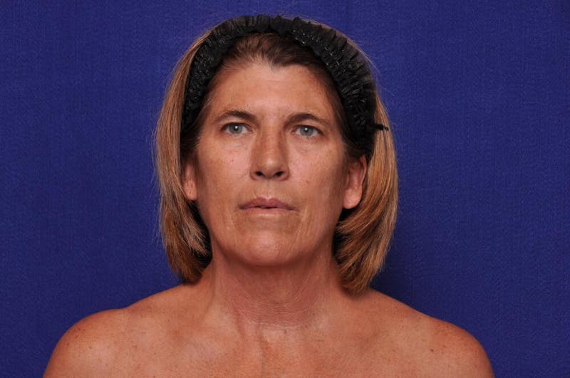 Brow Lift Before & After Gallery - Patient 119408 - Image 5