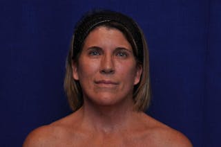 Brow Lift Before & After Gallery - Patient 119408 - Image 6