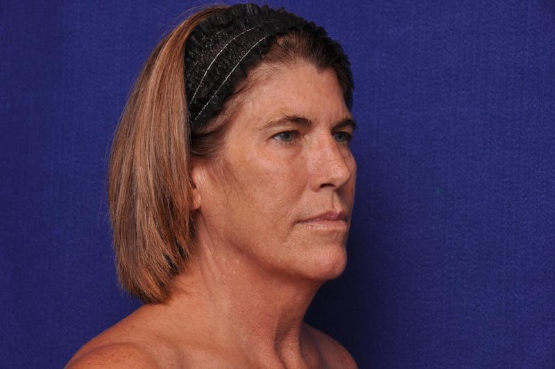 Brow Lift Before & After Gallery - Patient 119408 - Image 7