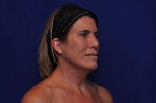 Brow Lift Before & After Gallery - Patient 119408 - Image 8