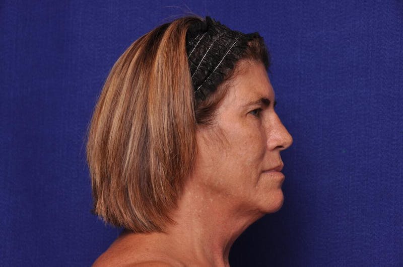 Brow Lift Before & After Gallery - Patient 119408 - Image 9