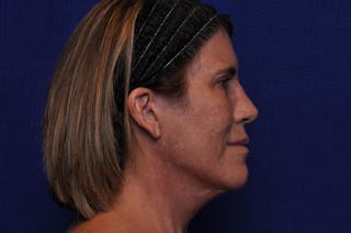 Brow Lift Before & After Gallery - Patient 119408 - Image 10
