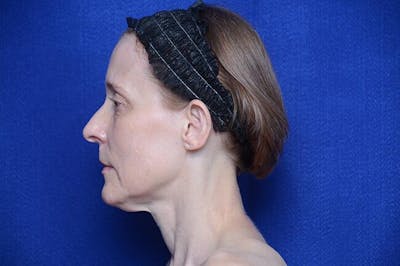 Brow Lift Before & After Gallery - Patient 172845 - Image 1