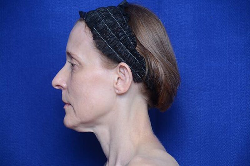 Brow Lift Before & After Gallery - Patient 172845 - Image 1