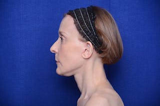 Brow Lift Before & After Gallery - Patient 172845 - Image 2