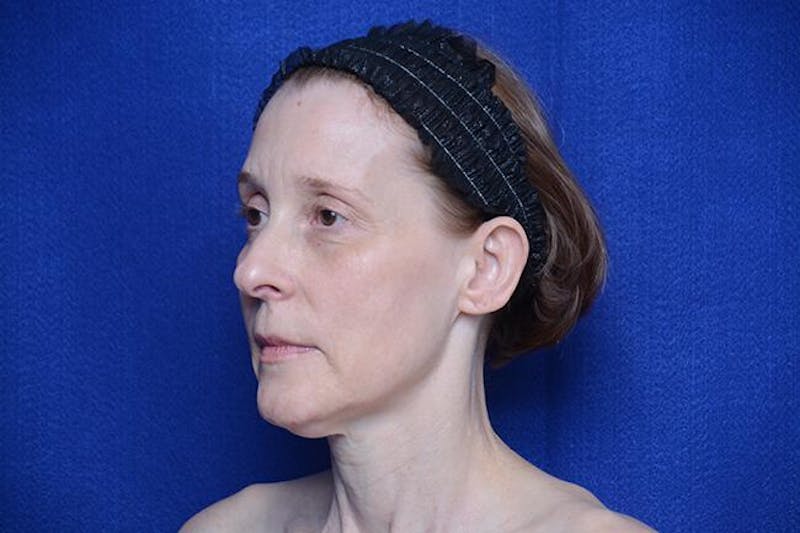 Brow Lift Before & After Gallery - Patient 172845 - Image 3