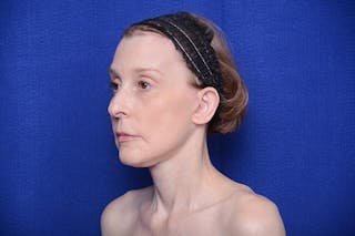 Brow Lift Before & After Gallery - Patient 172845 - Image 4