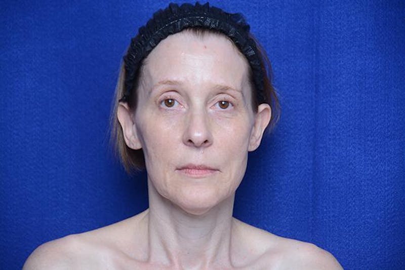 Brow Lift Before & After Gallery - Patient 172845 - Image 5