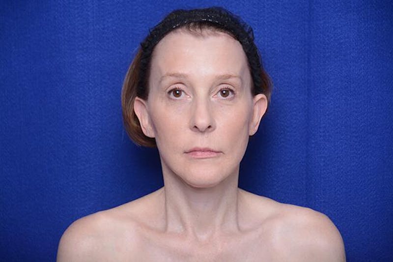 Brow Lift Before & After Gallery - Patient 172845 - Image 6