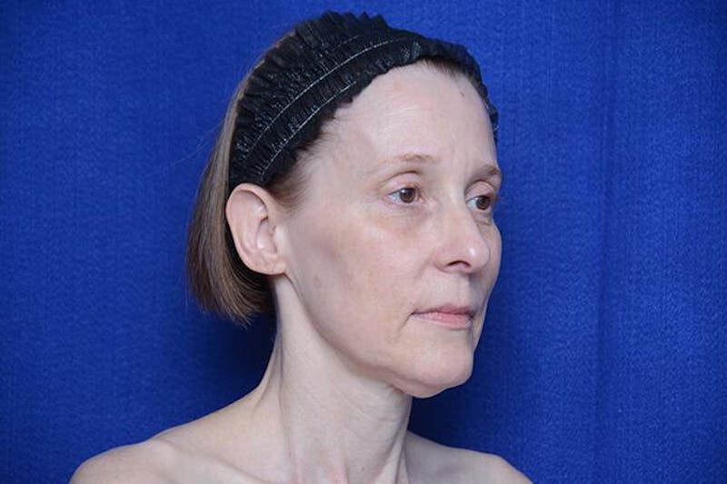Brow Lift Before & After Gallery - Patient 172845 - Image 7