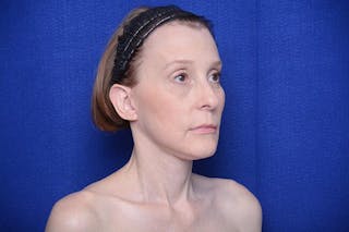 Brow Lift Before & After Gallery - Patient 172845 - Image 8
