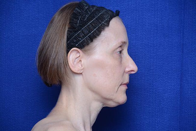 Brow Lift Before & After Gallery - Patient 172845 - Image 9