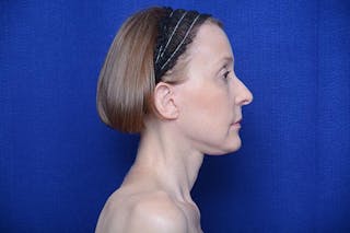 Brow Lift Before & After Gallery - Patient 172845 - Image 10