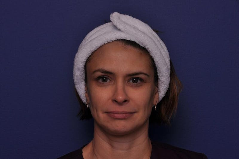 Chemical Brow Lift Before & After Gallery - Patient 189306 - Image 1