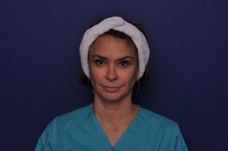 Chemical Brow Lift Before & After Gallery - Patient 189306 - Image 2