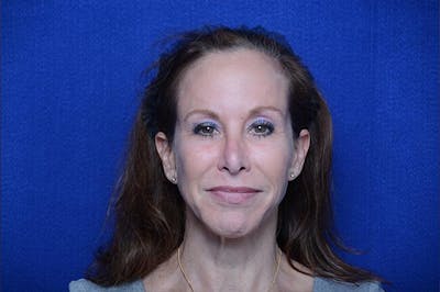 Chemical Brow Lift Before & After Gallery - Patient 265380 - Image 1