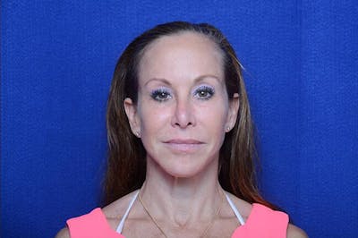 Chemical Brow Lift Before & After Gallery - Patient 265380 - Image 2