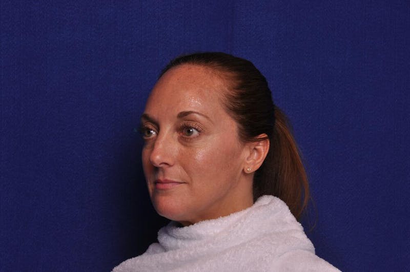 Chemical Brow Lift Before & After Gallery - Patient 358336 - Image 3