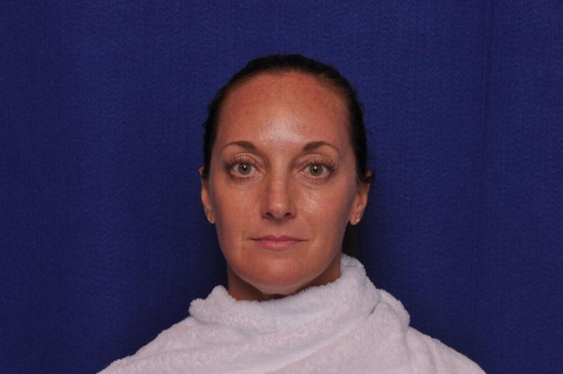 Chemical Brow Lift Before & After Gallery - Patient 358336 - Image 1