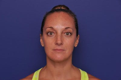 Chemical Brow Lift Before & After Gallery - Patient 358336 - Image 2