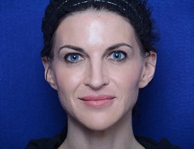 Chemical Brow Lift Before & After Gallery - Patient 334454 - Image 1