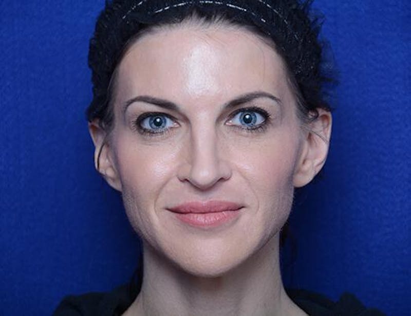 Chemical Brow Lift Before & After Gallery - Patient 334454 - Image 1