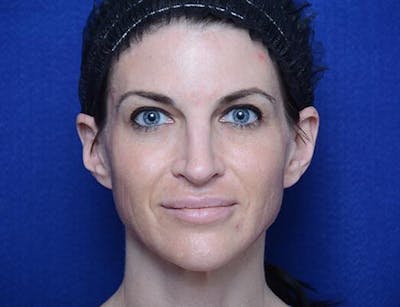 Chemical Brow Lift Before & After Gallery - Patient 334454 - Image 2
