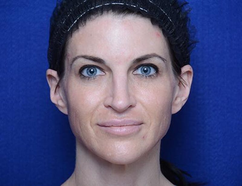 Chemical Brow Lift Before & After Gallery - Patient 334454 - Image 2