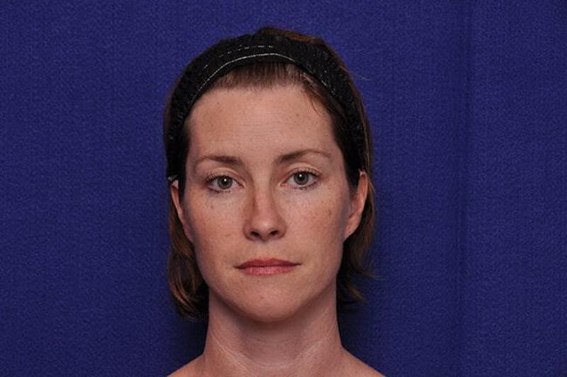 Chemical Brow Lift Before & After Gallery - Patient 254535 - Image 1