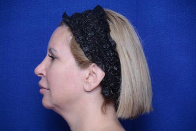 Chin Implant Before & After Gallery - Patient 198217 - Image 1